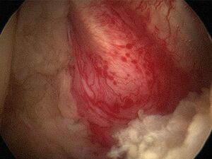 Bild frozen Schulter Arthrofibrose