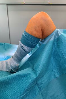Bild Knie seitlich im OP