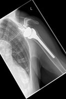 Bild neue Schultergelenksprothese nach OP