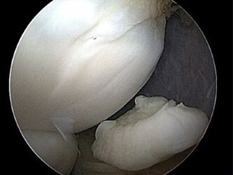 Bild Fragment Ellenbogen bei Osteochondrosis dissecans