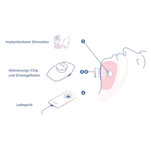 Abbildung von einem Zungenschrittmacher
