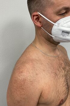 Bild Patient nach arthrokopischer Rotatorenmanschettenrekonstruktion