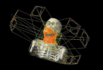 Bild 4D Bestrahlungsplanungssystem Eclipse der Firma Varian