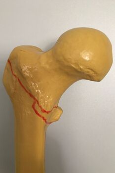 Bild Frakturverlauf pertrochantaere Fraktur Modell