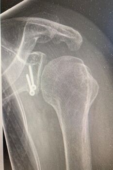 Bild Latarjet Stabilisation