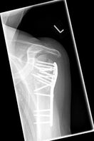 Bild von Plattenosteosynthese links auswärtig