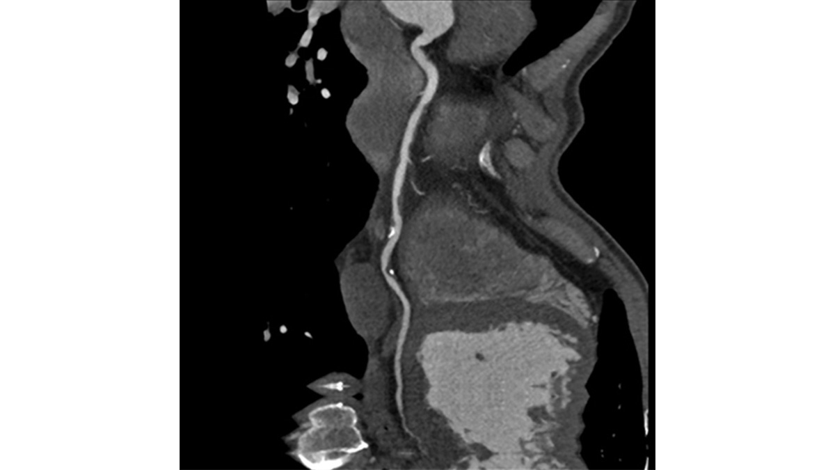 Herz und Gefäßerkrankungen werden bei der Computertomographie sichtbar