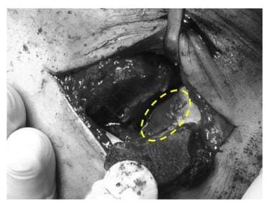 Röntgenbild der geschädigte Gelenkbereich des Sprungbeines wurde mit Eigenknochen aufgefüllt und mit einer Kollagenmatrix bedeckt