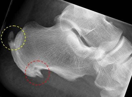 Röntgenbild Fersensporn