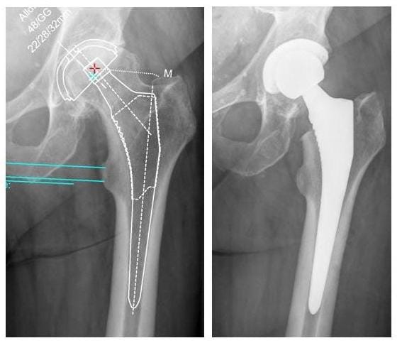 Bild Röntgenbild Hüftprothese