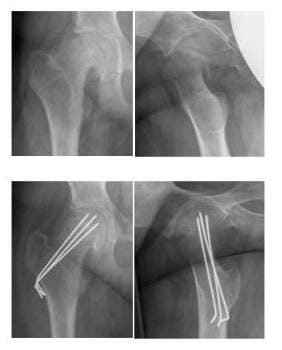 Die Bilder zeigen den abgerutschten Hüftkopf aus 2 Perspektiven und zeigen das Ergebnis nach Einrichtung und Sicherung mit Drähten