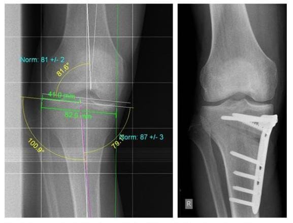 Röntgenbild nach Analyse der Fehlstellung erfolgte die Korrektur eines O-Beines durch eine medial aufklappende Umstellungsosteotomie