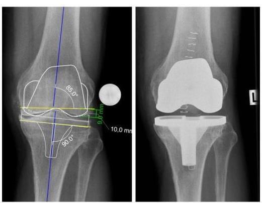 Röntgenbild Prothesenplanung Knie