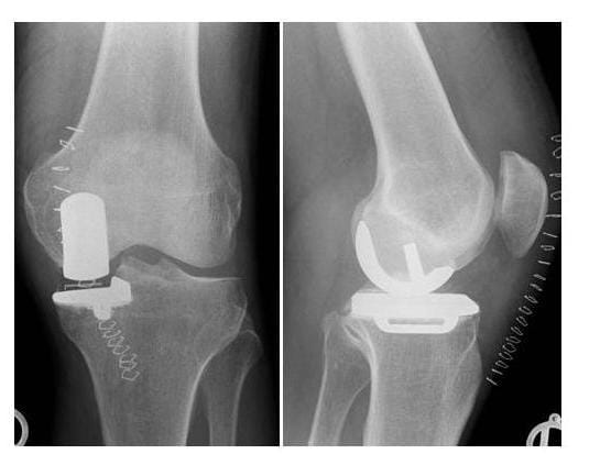 Röntgenbild Unikondylaerer Oberflächenersatz