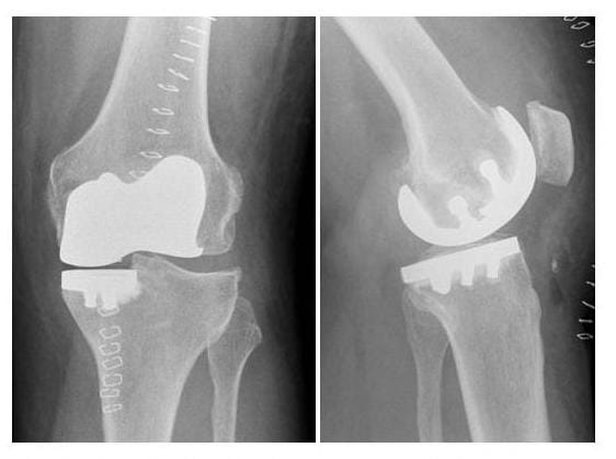 Röntgenbild individuell angefertigter Oberflächenersatz