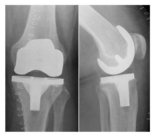 Röntgenbild Bikondylärer Oberflächenersatz