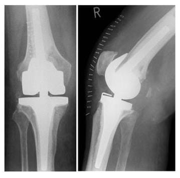Röntgenbild gekoppelte Knieprothese