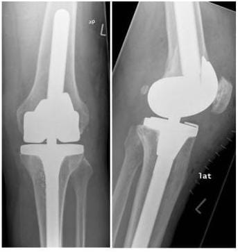 Röntgenbild modular gekoppelte Knieprothese