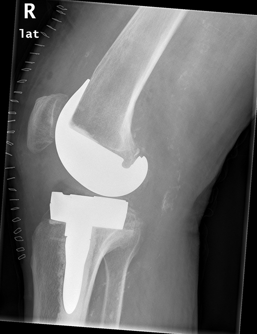 Röntgenbild Versorgung mit Roboter assistierter Knieprothese