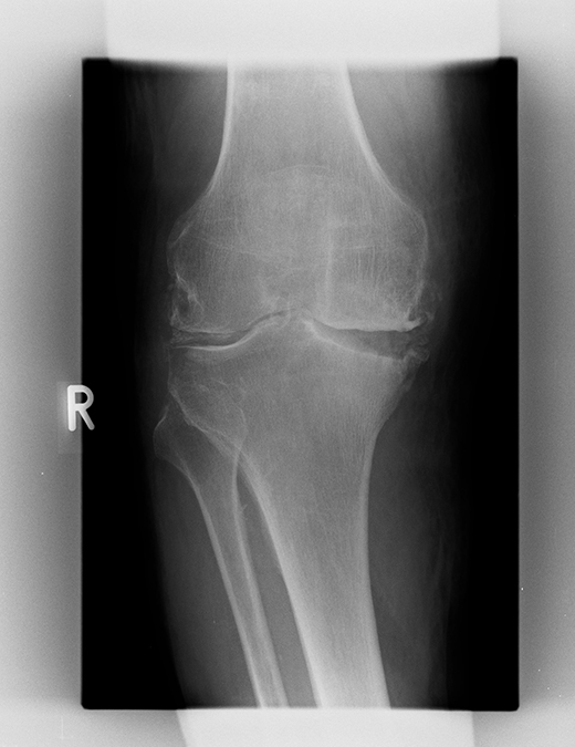 Röntgenbild fortgeschrittene O Bein-Arthrose rechts