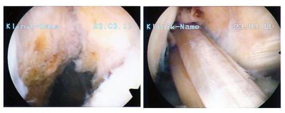 Bild links zeigt das fehlende vordere Kreuzband rechts ist es durch körpereigenes Sehnengewebe ersetzt worden