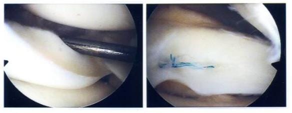Röntgenbild links sieht man den abgerissenen Meniskus rechts sieht man die Naht