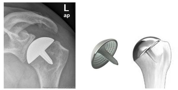 Röntgenbild Oberflächenersatz mit einer Kappenprothese