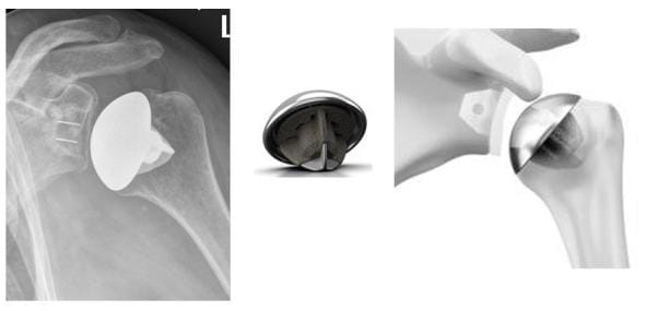 Röntgenbild schaftlose anatomische Schulterprothes