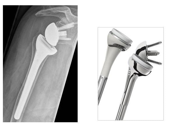 Röntgenbild inverse Schulterprothese