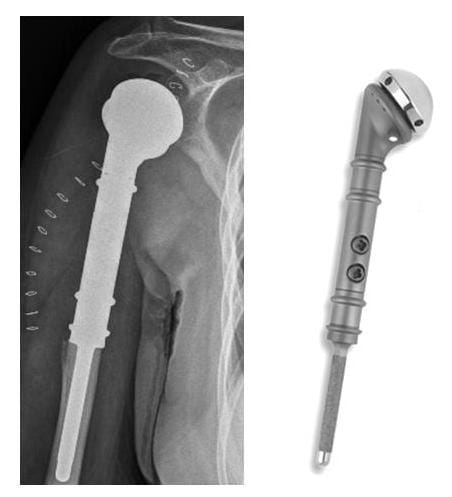 Röntgenbild Tumorprothese