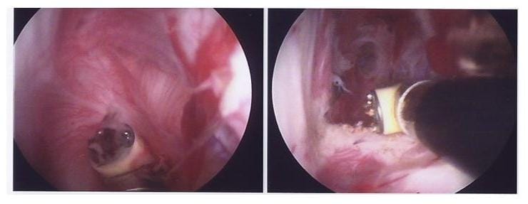 Bild die entzündete Gelenkkapsel wird in Schlüssellochtechnik gelöst