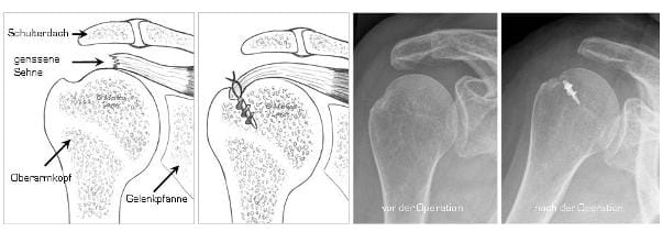 Die Schemazeichnung links zeigt wie ein Sehnenriss genäht werden kann rechts sieht man die Röntgenkontrolle nach einer Sehnennaht mit einem Nahtanker