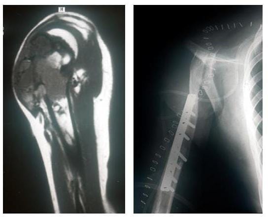 Röntgenbilder eines bösartigen Knochentumors des Oberarms und Tumorentfernung und Ersatz durch das geschwenkte Schlüsselbein