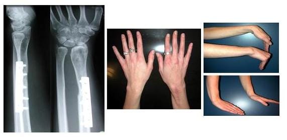 Bilder eines bösartiger Knochentumor der Speiche wurde nach Entfernung durch einen Teil des Wadenbeins ersetzt