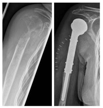Röntgenbild der bösartige Tumor wurde entfernt und das betroffene Schultergelenk durch eine Tumorprothese ersetzt