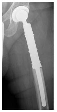 Röntgenbild Ersatz des Hüftgelenkes und oberen Anteils des Oberschenkelknochens durch eine Prothese