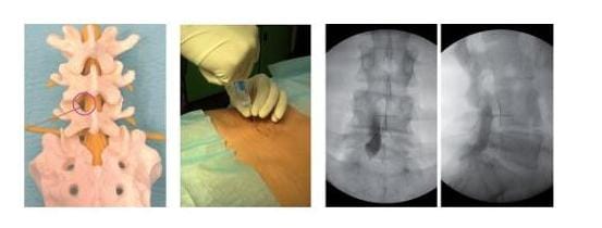 Beispiel einer Injektionsbehandlung bei einem Bandscheibenvorfall