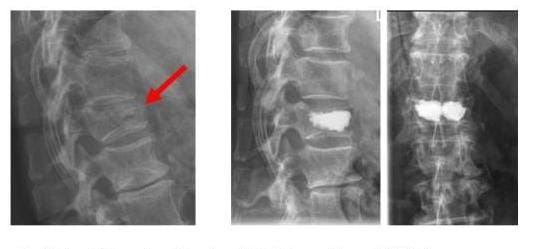 Röntgenbild links zeigt einen Wirbelkörpereinbruch rechts der Wirbelkörper wurde mit Zement aufgefüllt und so stabilisiert