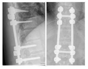 Röntgenbild ein Wirbelkörper wurde mit einem Doppelstabsystem überbrückt