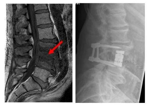 Das Röntgenbild zeigt die ausgedehnte Infektion der Bandscheibe und angrenzenden Knochen das infizierte Gewebe wurde entfernt und die Wirbelsäule mit einem Doppelstabsystem und einem Cage stabilisiert
