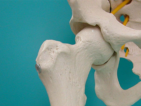 Bild künstliches Hüft Modell