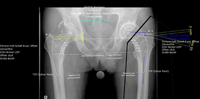 Bild präoperative Planung Hüft