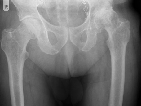 Bild Coxarthrose links Piater