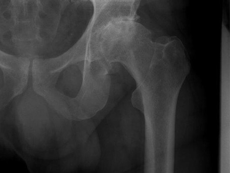 Bild coxarthrose links