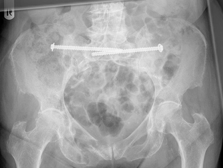 Bild Beckenringfraktur Verschraubung