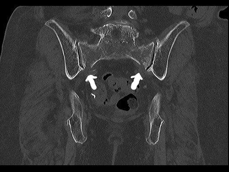Bild hintere beiderseitige Kreuzbeinfraktur