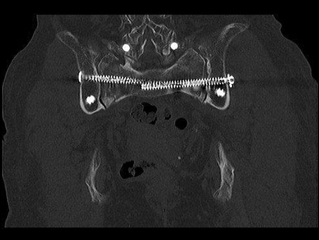 Bild sacrum postoperativ