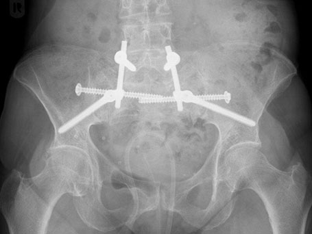 Bild sacrum postoperativ