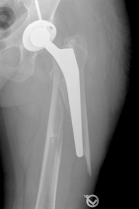 Bild periprothetische Fraktur vor OP