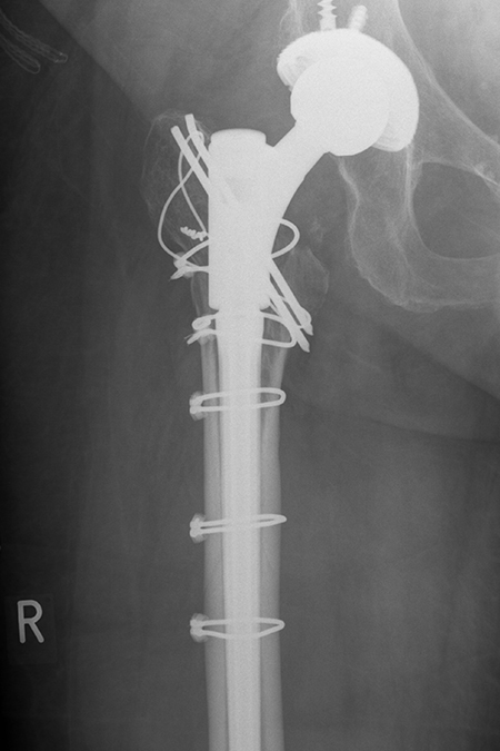 Bild periprothetische Fraktur nach OP